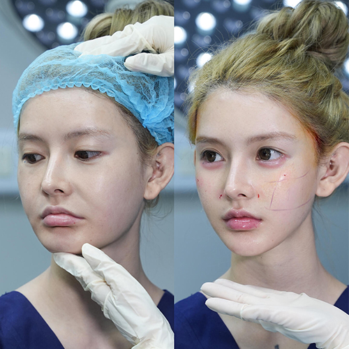 3Dfacelift