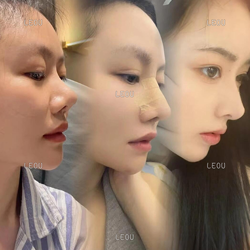 Rhinoplasty