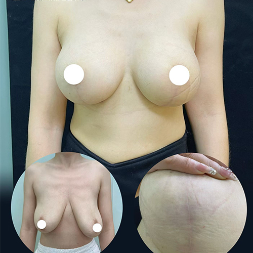 Breast lift
