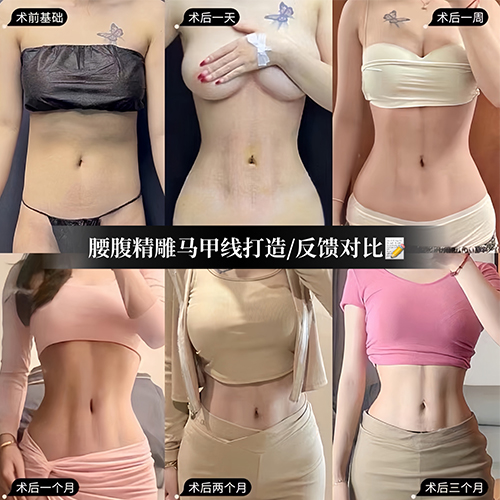 Abdominal lipo