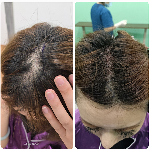 Hair grafting
