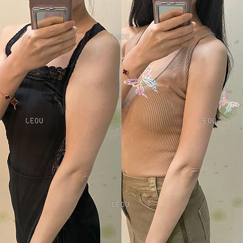 Arm liposuction