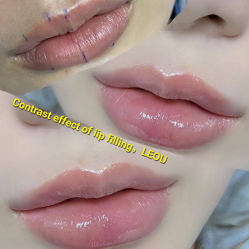 Lip surgery