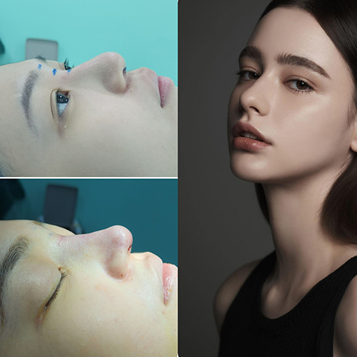 Nose Repair