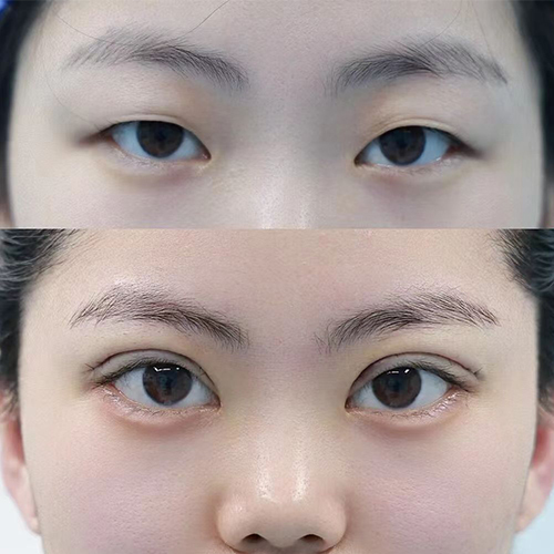 Eye