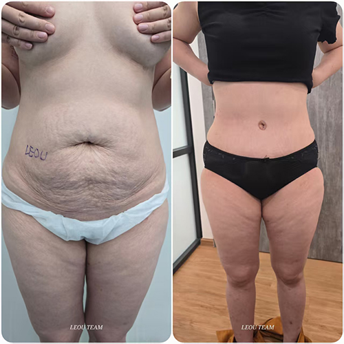 Tummy Tuck