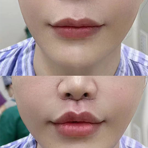 Philtrum shorten